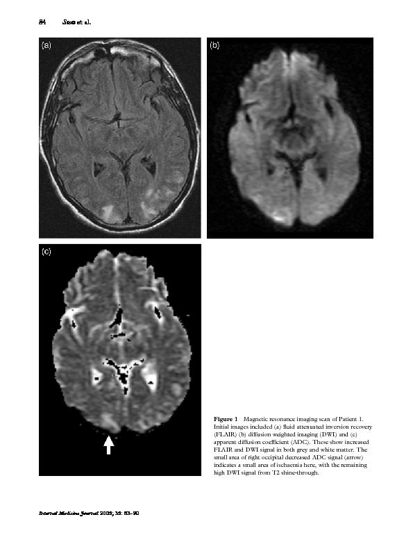 Download Reversible posterior leunkoencephalopathy (RPL) syndrome - a misnomer reviewed.